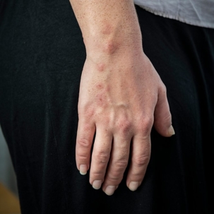 how long do bed bug bites last?