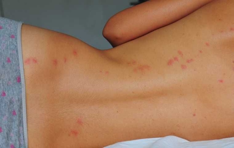 bed bug bites