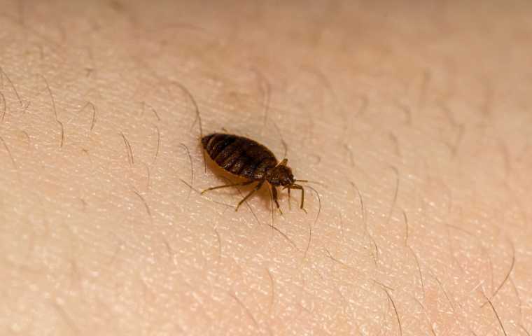 treating bed bug bites